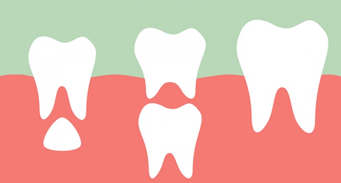 etapas en los dientes