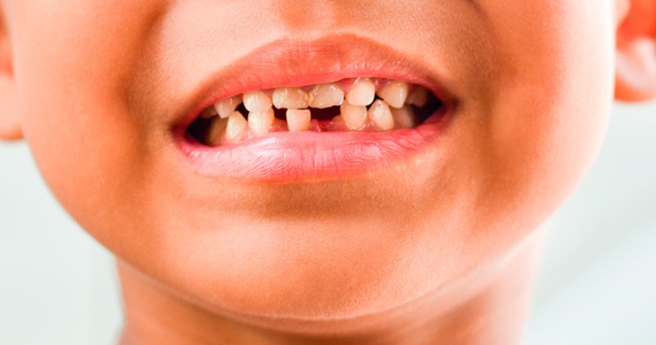 mala oclusion de los dientes
